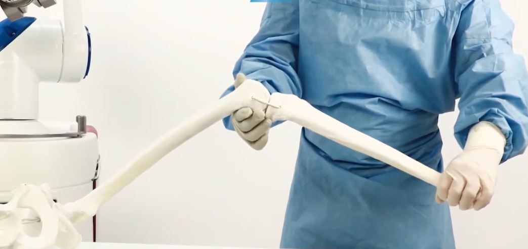 মণিপাল হাসপাতাল রোসা রোবোটিক সহায়তায় হাঁটু সার্জারির উন্মোচন !