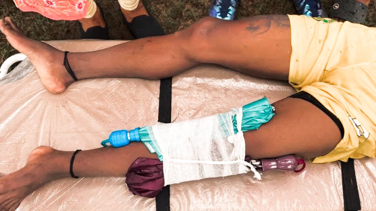 মান্ধাতা আমলের ফুটবল পরিকাঠামো, কলকাতা লিগের করুণ ছবি- ছাতা দিয়ে খেলোয়াড়ের পায়ে ব্যান্ডেজ বাঁধা হল!