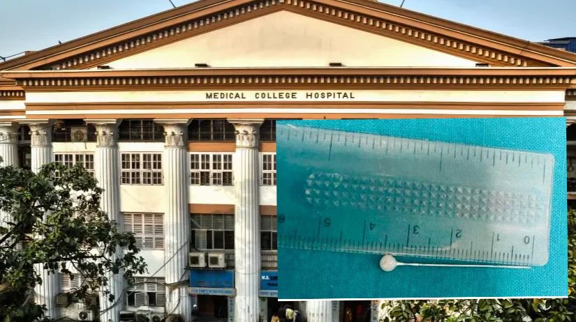 সাত বছরের শিশুর শ্বাসনালিতে  মহিলার খোঁপার পিন,কলকাতা  মেডিক্যাল কলেজের চিকিৎসকদের দক্ষতায় বাঁচল প্রাণ!